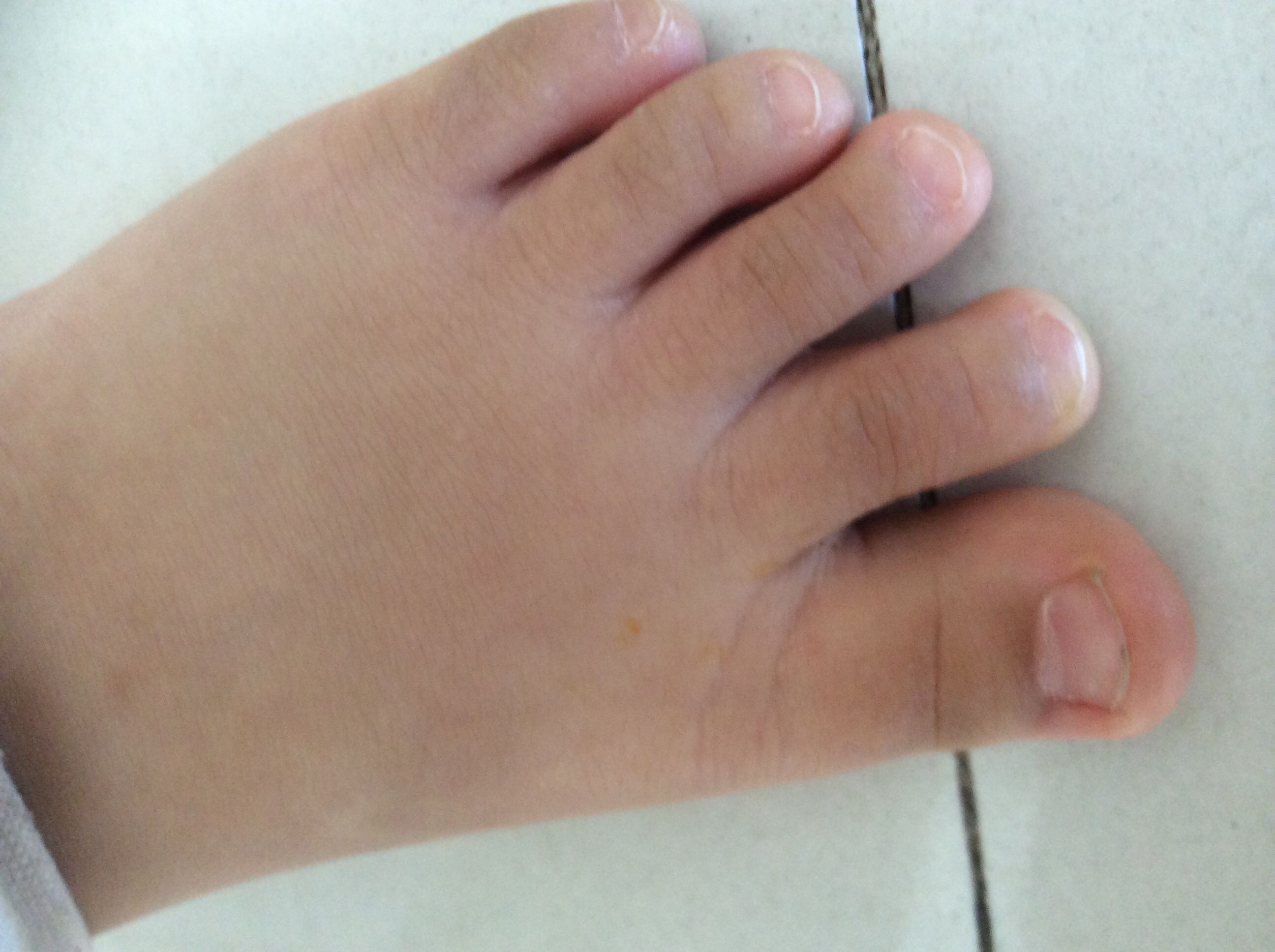 儿童指甲上有凹陷小坑图片