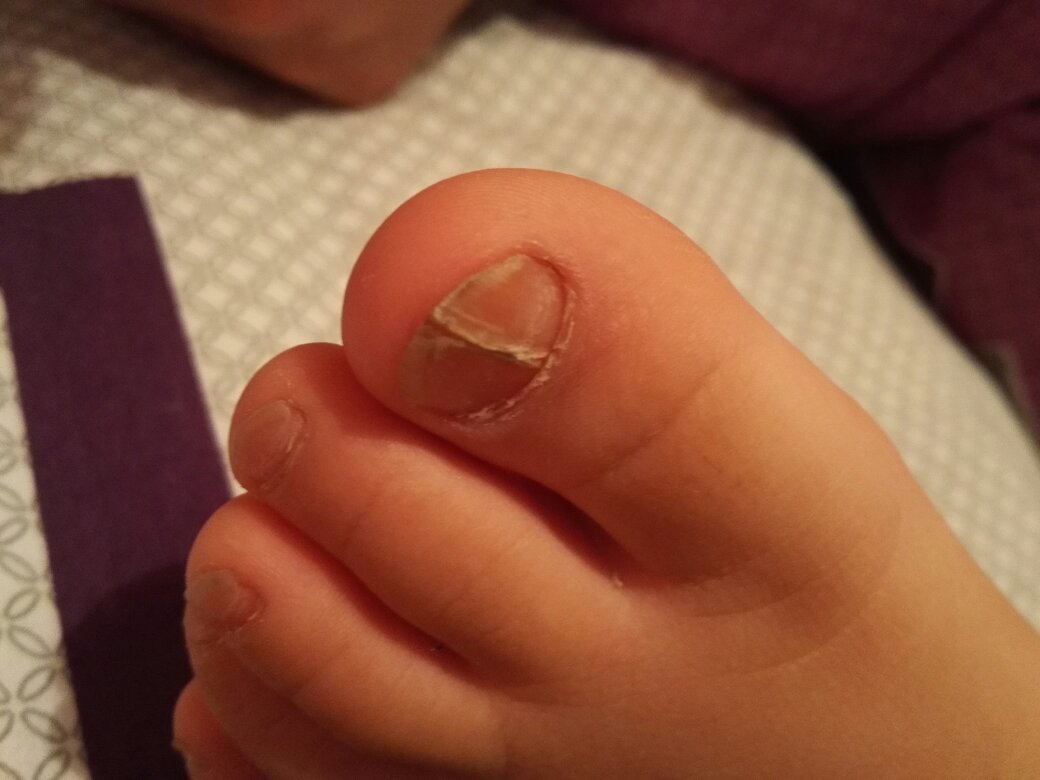 小孩脚指甲,去检查也没查出啥,求知道