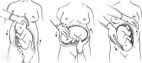 外倒转术：用以上方法纠正胎位无效者，一般可在妊娠30周以后，到医院由