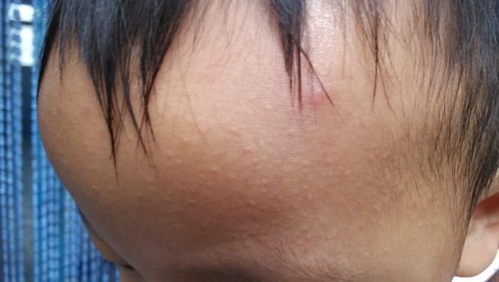 小孩额头起疙瘩,请问什么原因