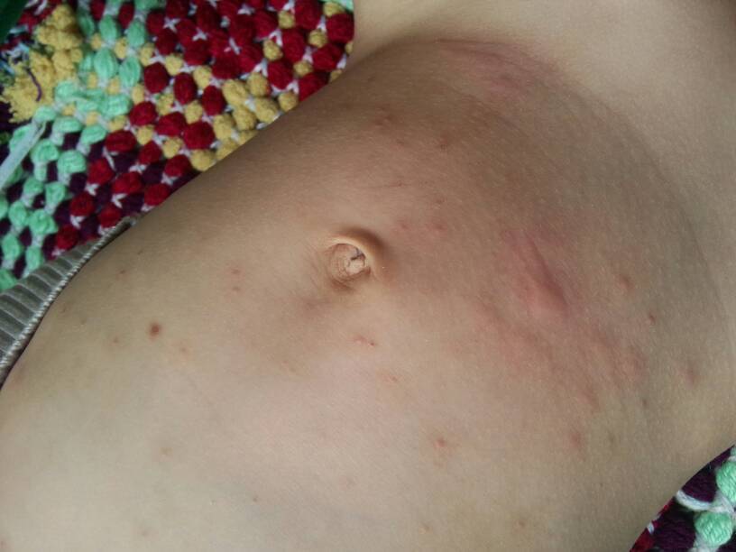 小孩5岁,病情一周,看过两次,分别是村诊所和乡诊所,没感觉 该怎么痒还