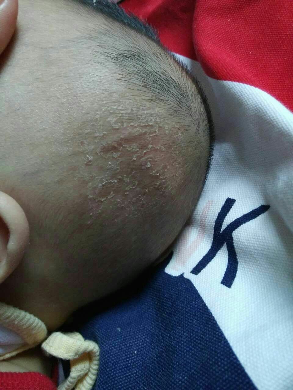 六个半月宝宝头上是怎么回事?