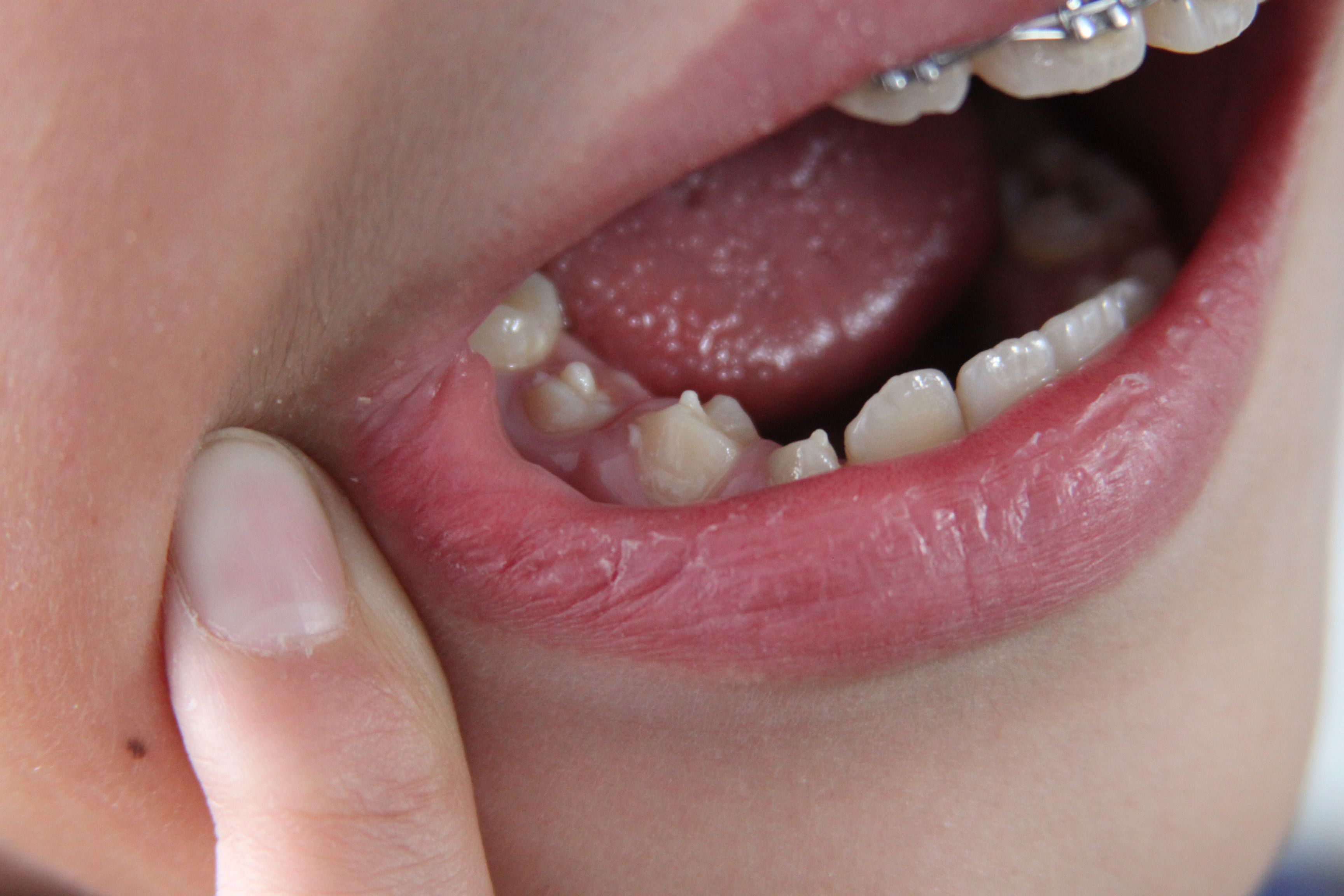 为什么孩子新换的牙齿呈锯齿状-有来医生