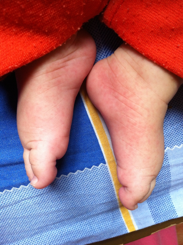 急5个半月宝宝手脚皮里起红点,怎么回事?还有,最近宝宝老拉青屎