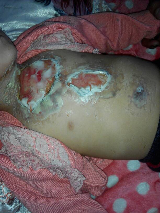 女婴烧伤图片