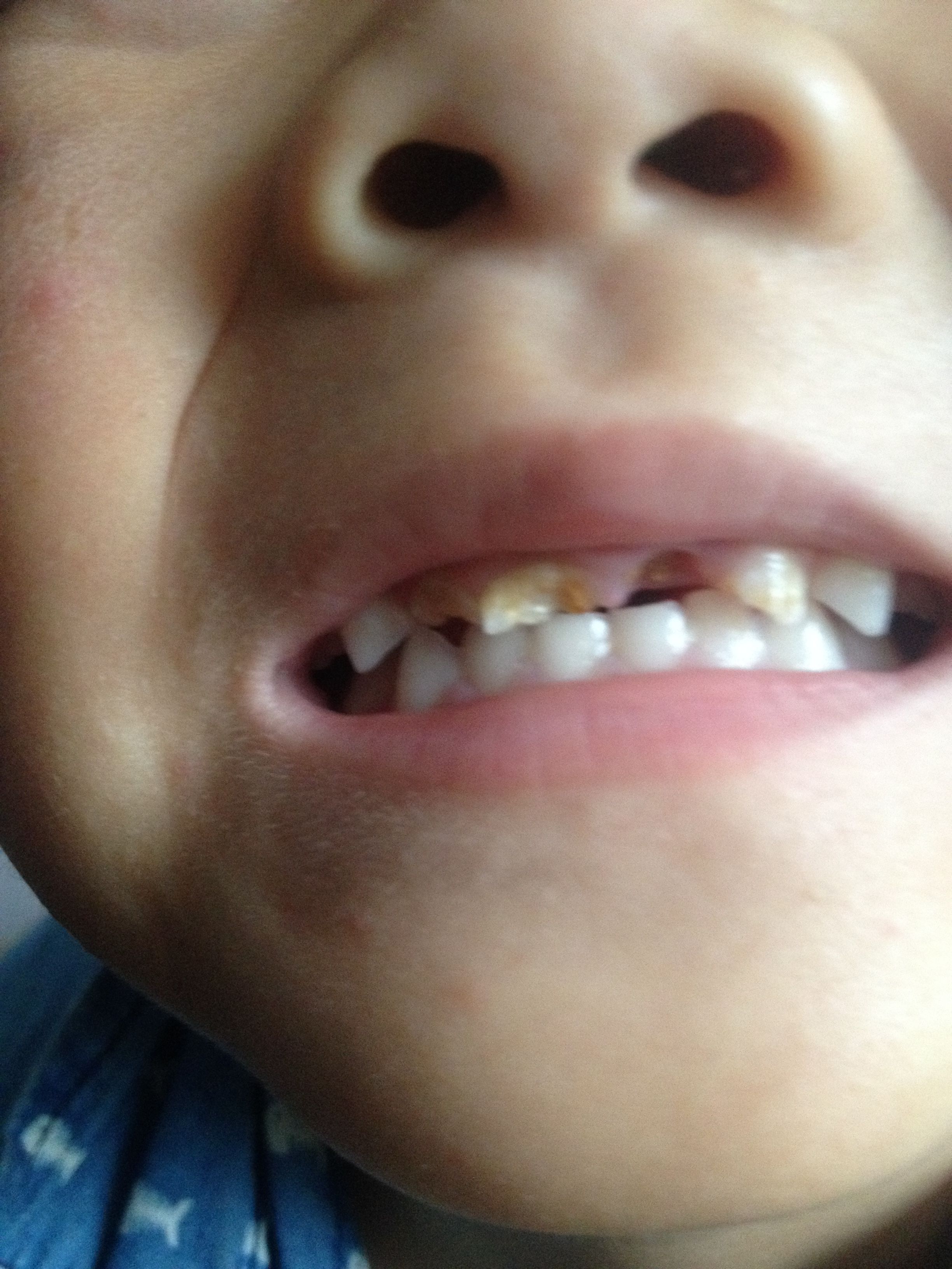 3岁半宝宝牙齿烂了,全是洞,怎么办啊