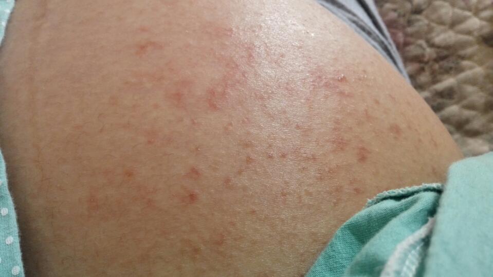 肚子上长了红色痘痘,又痒还会延,各位宝妈谁认识皮肤科的医生?