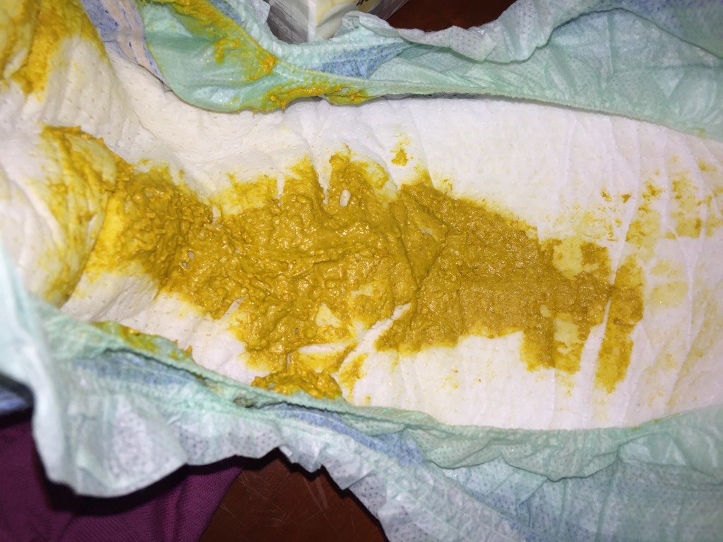 宝宝一个月零六天,眼睛周围黄,是不是有黄疸?