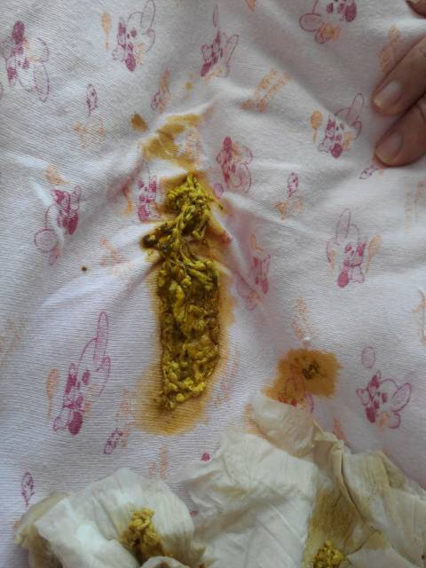 根据您的问题描述,为您回答如下: 从便便来看,怀疑是否为轮状病毒腹胃