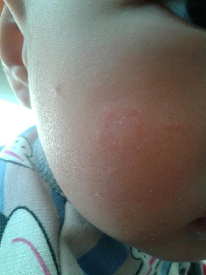 宝宝脸上长个斑,谁知道这是什么,求医生解答,就脸上长了一个