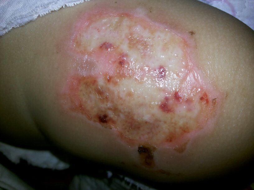 婴儿烫伤7天了,已经去医院就诊了,医生用生理盐水和美宝湿润烫伤膏