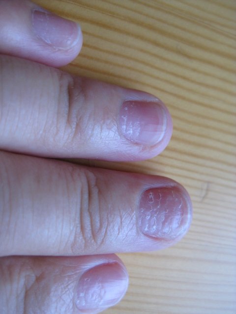 手指甲有横纹,坑坑哇哇的,好像是生完宝宝开始的,这种情况已经有半年