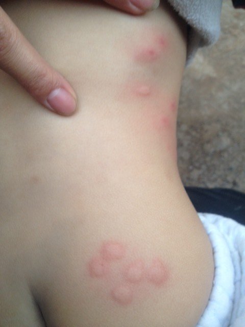 这是跳蚤咬的吗?用什么药才有用,宝宝不停的抓,看起来挺痒的