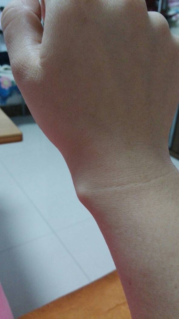 怀孕最后一个月得了腱鞘炎,现在宝宝四个多月了,还没好,需要做手术吗