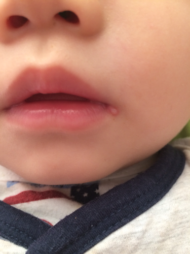 婴儿嘴角内侧疙瘩图片图片
