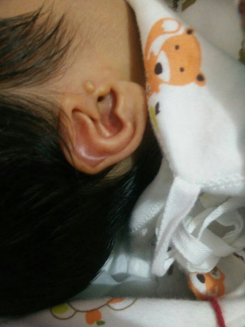 新生儿耳朵上有小肉丁图片
