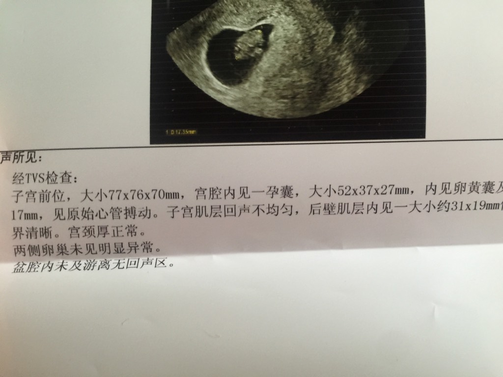孕8周孕囊大小图片