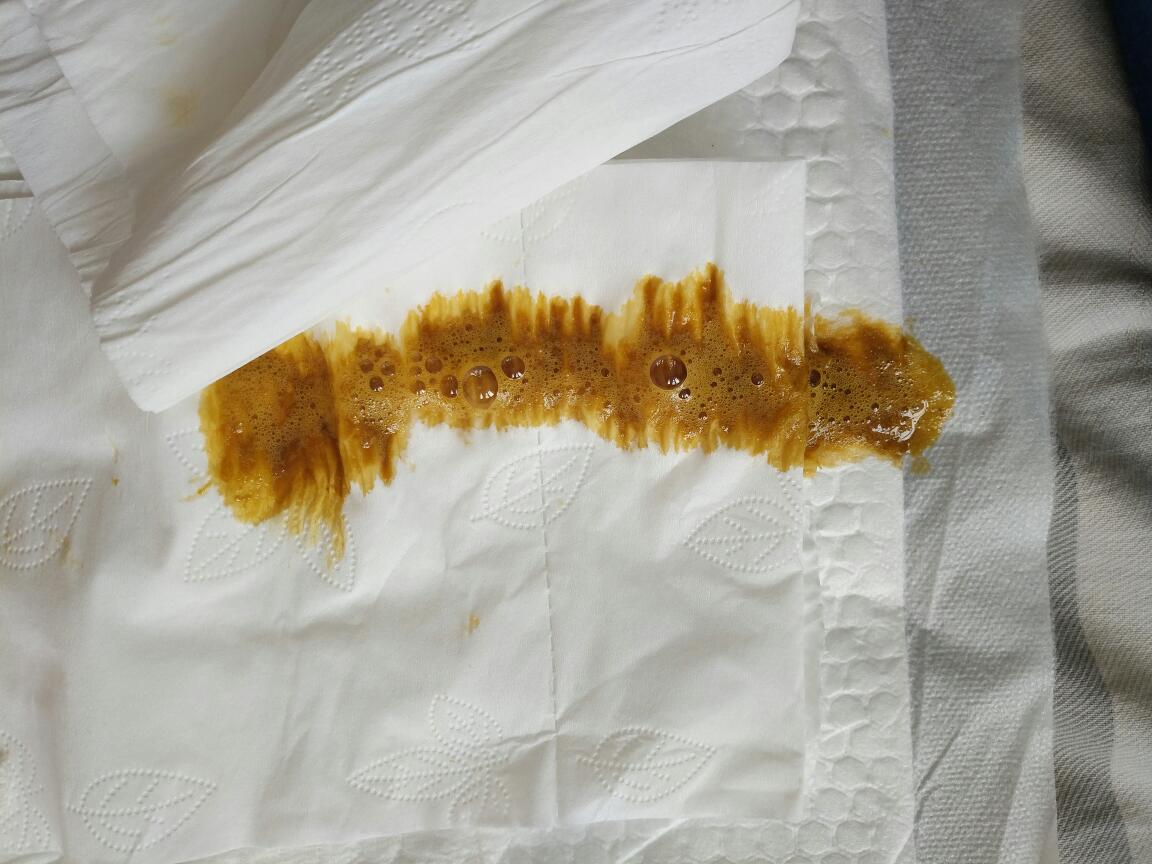 宝宝出11天拉的粑粑呈泡沫状,肚子有时候还咕噜咕噜的响,请问是怎么