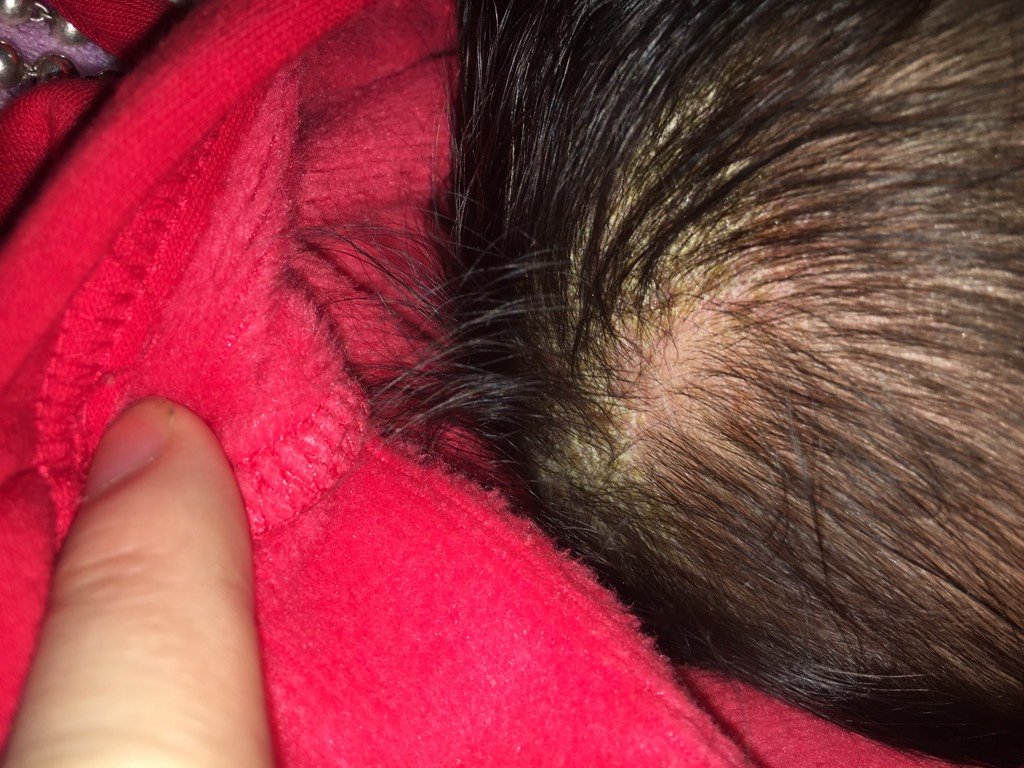 头上长结痂,前面都没有,一个多月才长出来,这是什么呀 - 百度宝宝知道