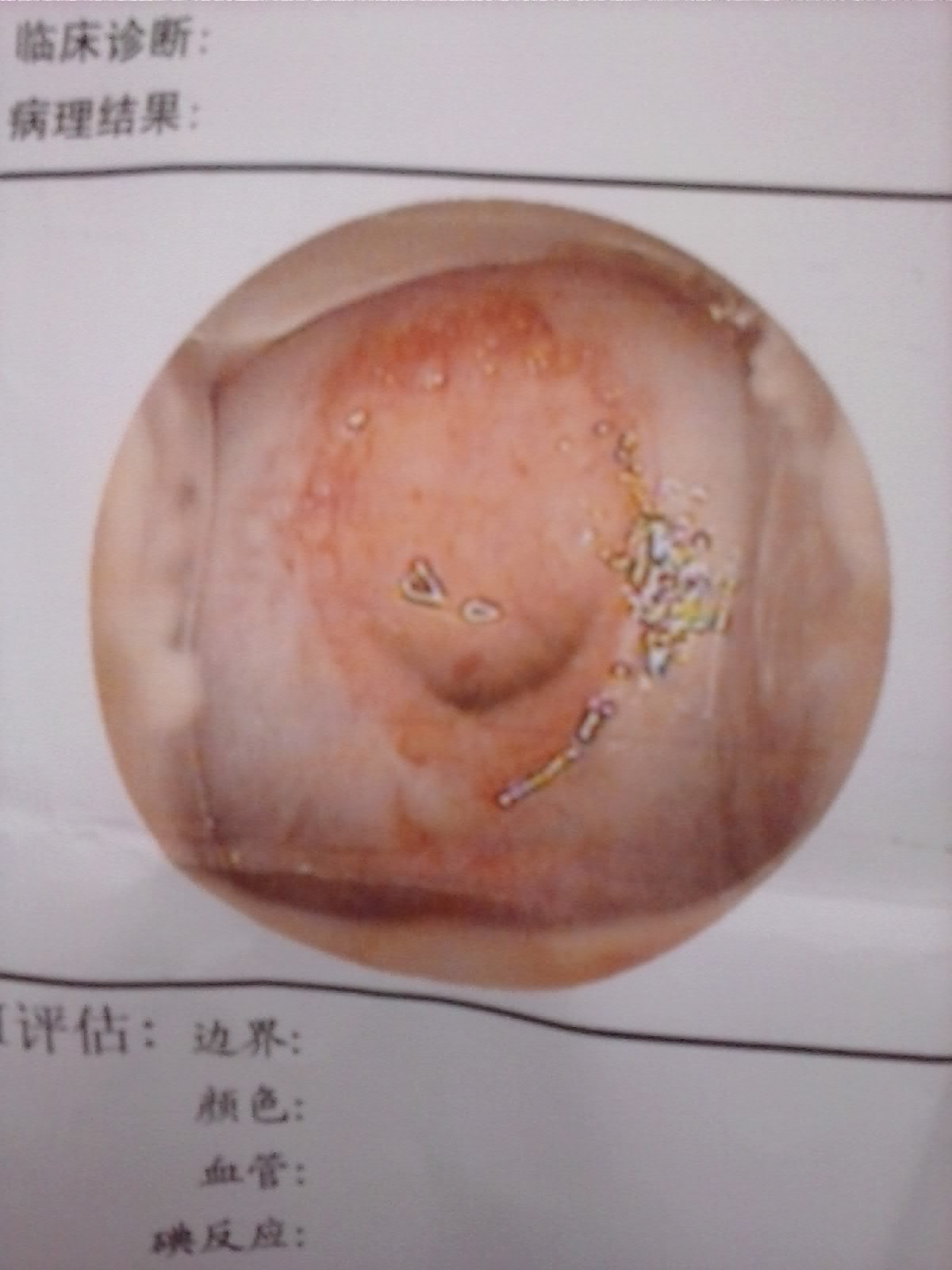 宫糜2度,除排卵期白带有血外没任何症状,该怎么治疗?