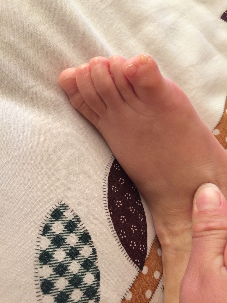 我女儿出世脚上多长个脚趾头现在三周岁半能割掉吗?