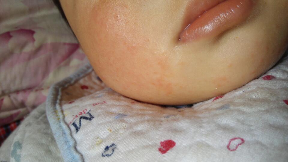 宝宝一岁半了,最近脸上起了一些红豆豆,不挠脸,应