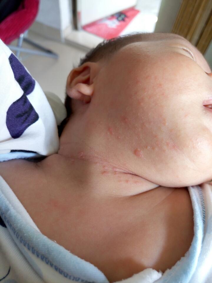 婴儿脖子上起疱疹图片图片