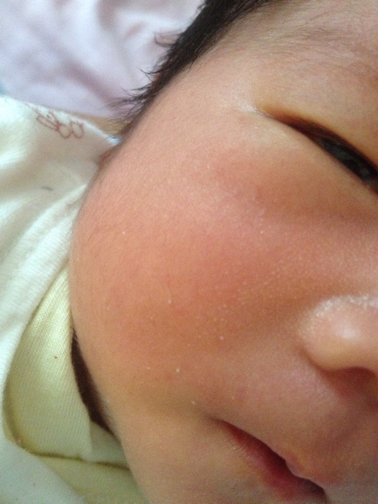 医生们,宝宝脸上长了白色小颗粒是什么,要怎么处理呢?求解