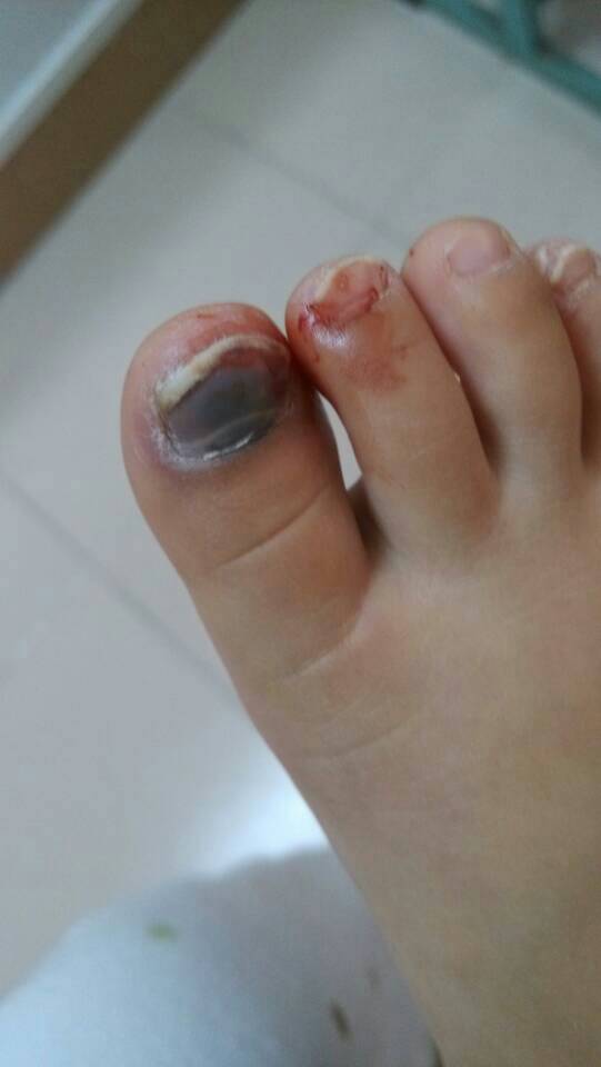 两岁九个月宝宝前天木板砸到脚趾头,没处理想等她慢慢好,但今天不小心