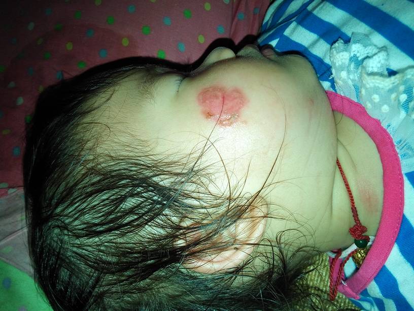 宝宝17个月前几天脸被蚊子咬了,被她自己抓破皮了,现在红肿发炎了好像