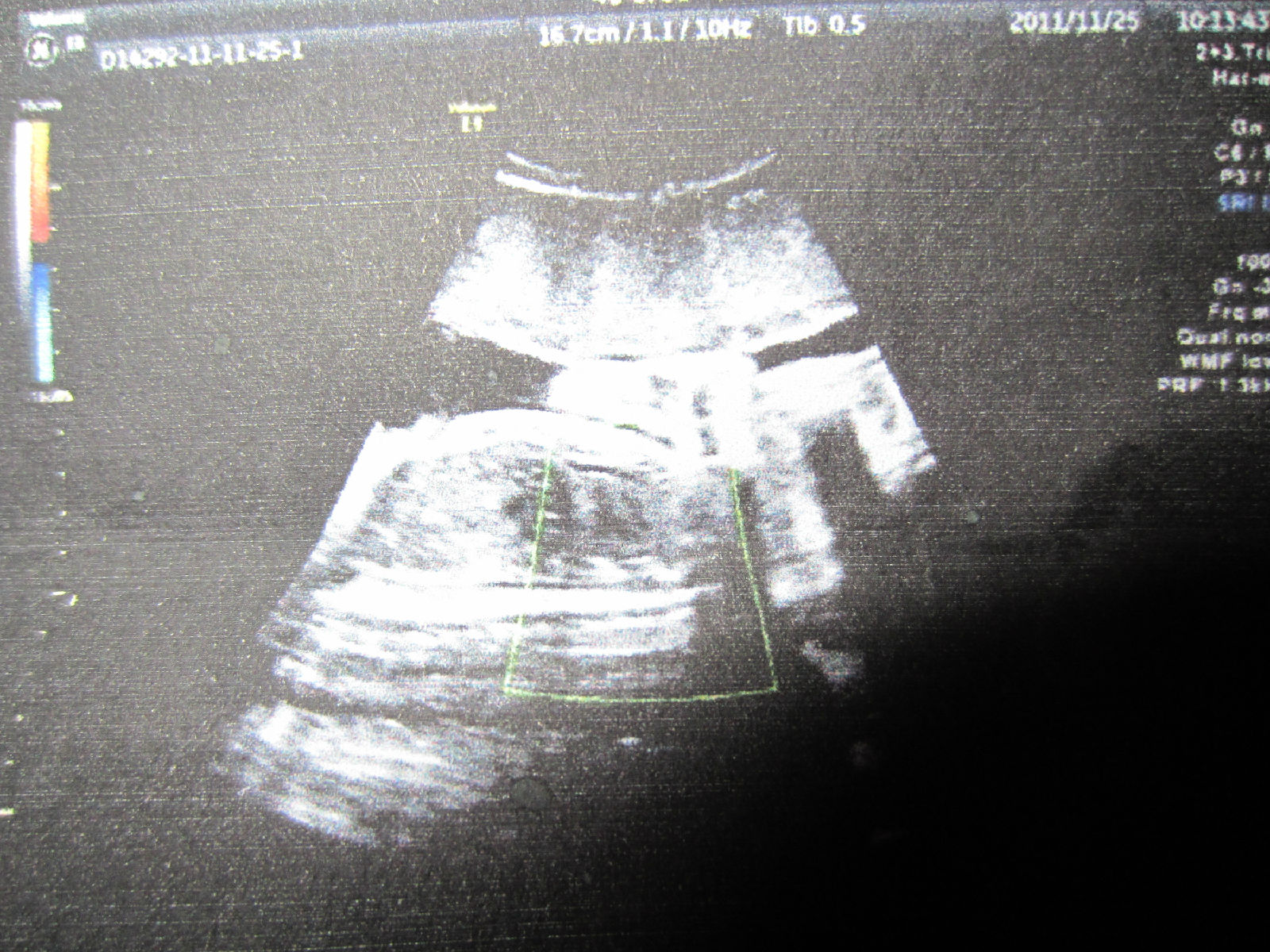 3个月医院检查B超，怀了双胞胎 上传了B超图大家帮我分析下 - 百度宝宝知道