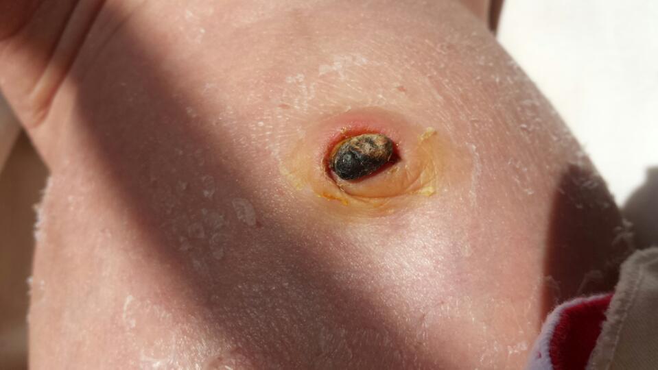 宝宝出生十七天脐带还没掉,周围有点红肿,是不是发炎了?