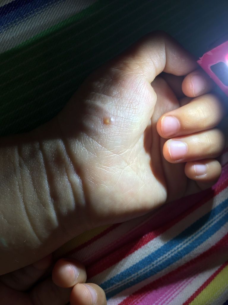 疱疹病毒感染引起第二手足口病病毒感染第三过敏因素引起的湿疹建议