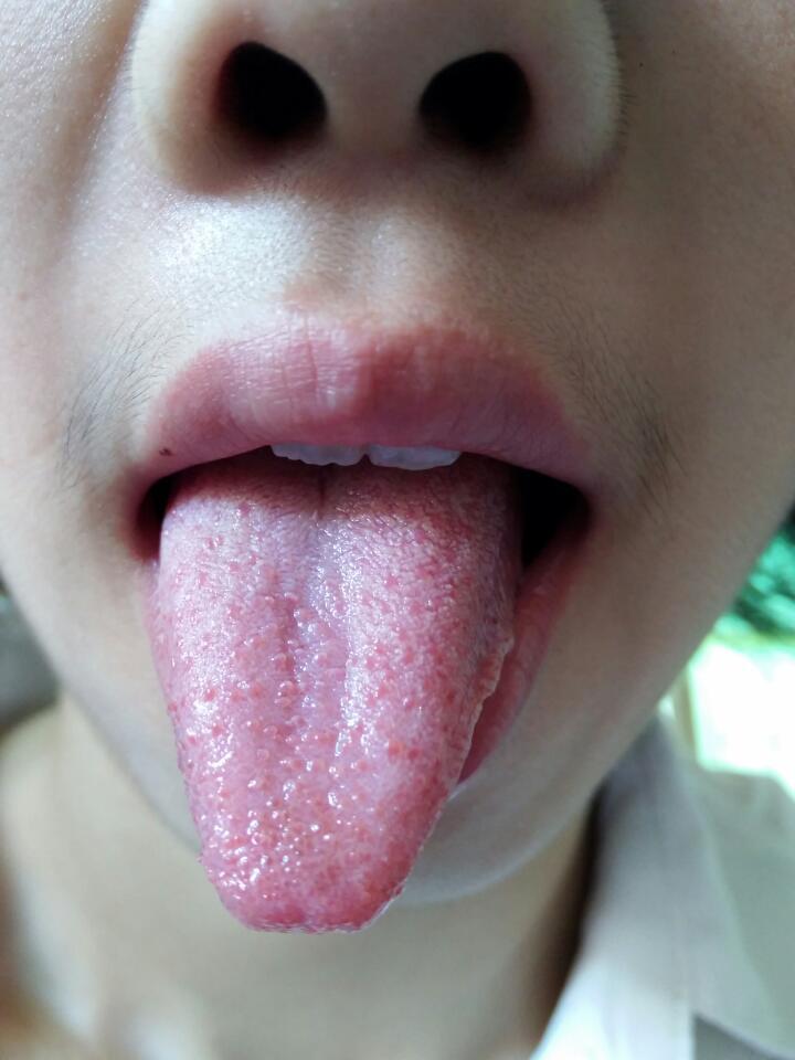 孕妈妈舌头有很多突起的红点点，，嘴唇还有一个痘