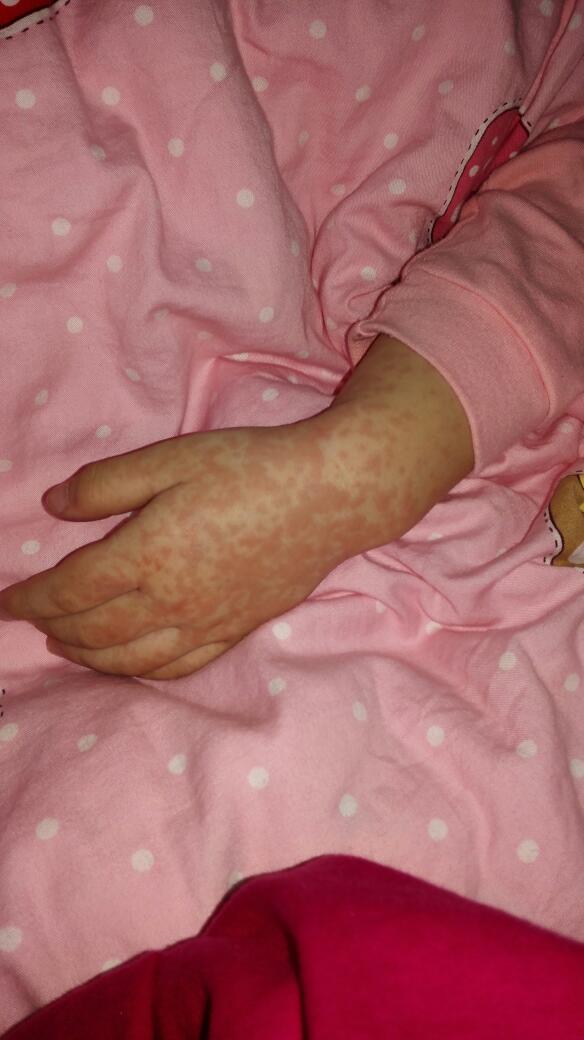 宝宝33个月,孩子发烧五天后,突然退烧,之后身上及四肢出现这样的红疹