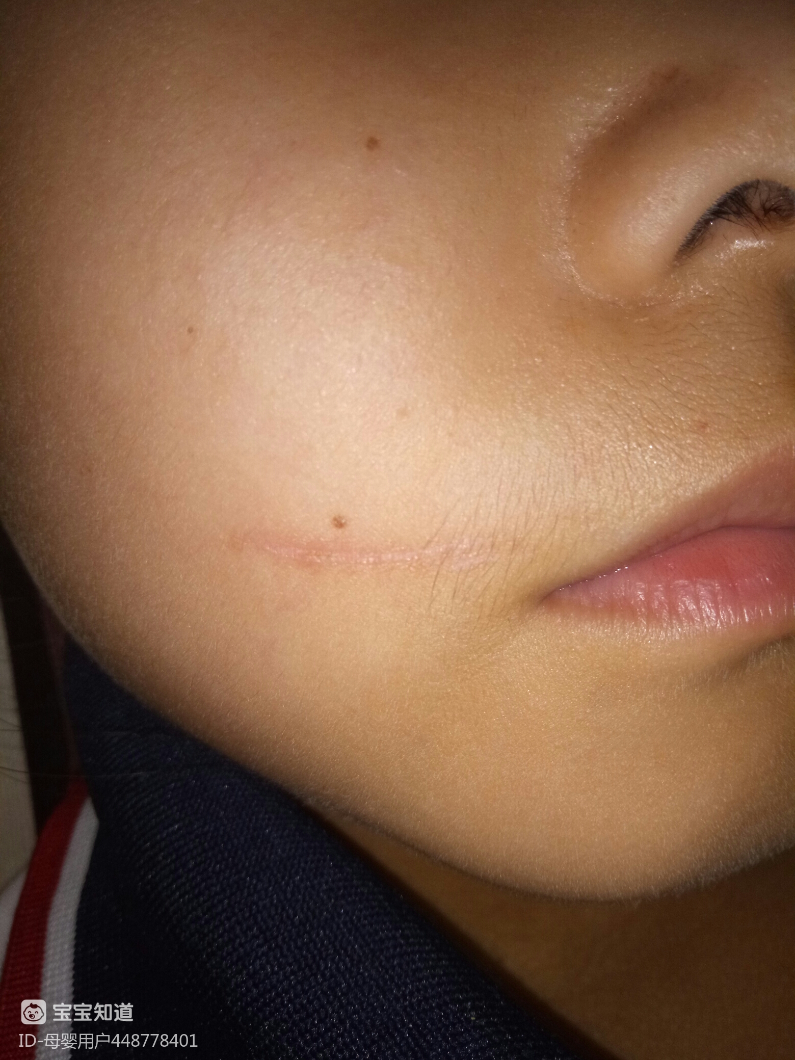 9岁闺女指甲划伤一周了这个印需要抹药吗能去掉吗