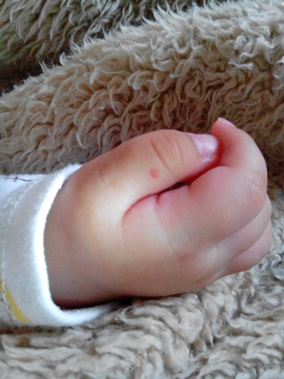 70 天的婴儿拇指上有个小米粒般大的红点,刚生时应该没有,一个月时才