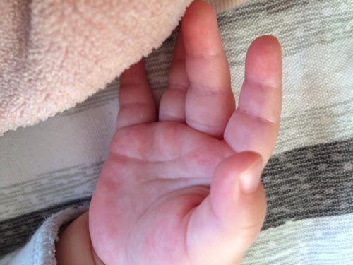 五个半月的宝宝,今天发现手掌上有两个泡泡,其他地方没有…是手足口吗