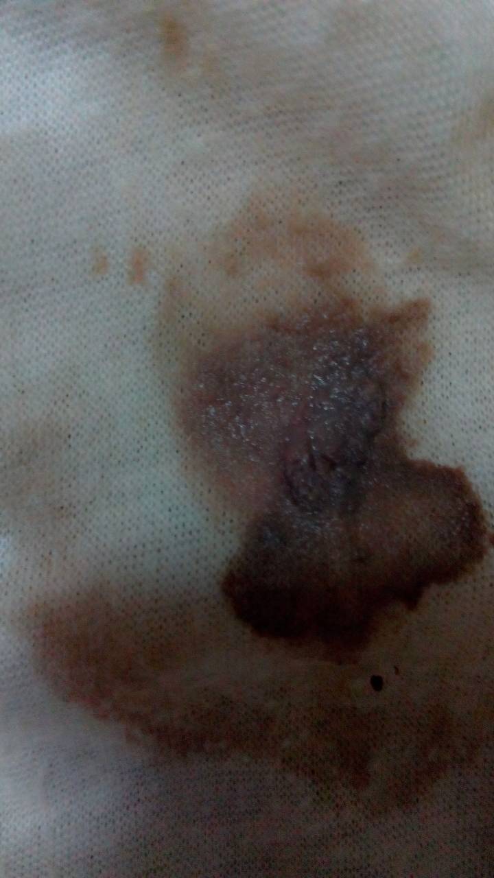 下身白带变成这种情况请问是什么问题,而且像豆腐渣还很痒 求解!谢谢!