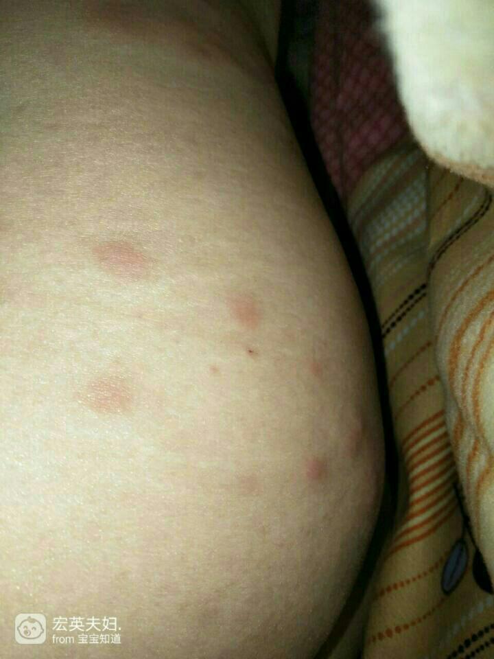孕晚期了这两天屁股长了好多红色疙瘩特别痒怎么办?