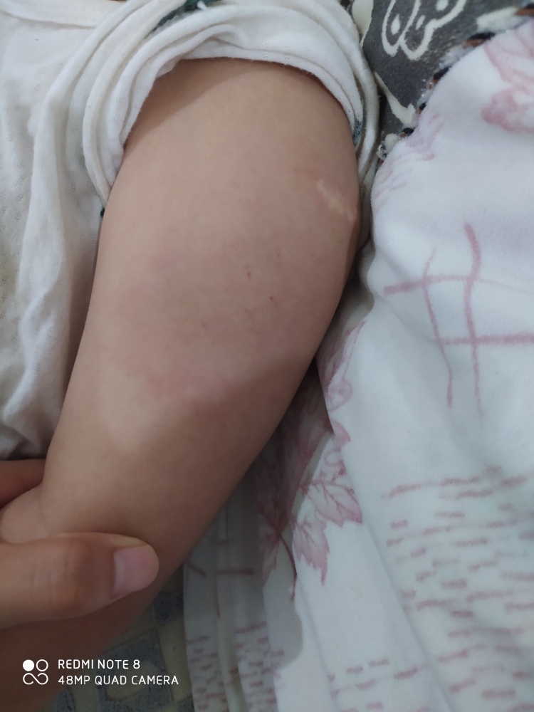 一岁7个月的宝宝打了百白破疫苗第四针后,胳膊红肿特别大
