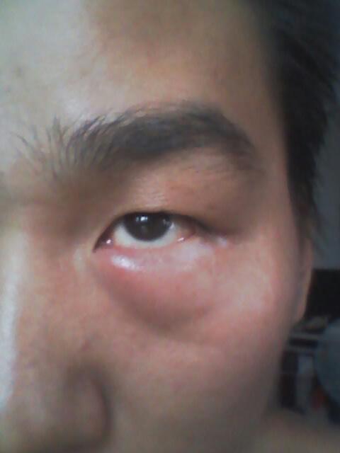 宝爸下眼皮肿 有点痛是怎么回事,应该怎么办?昨天有一点今天肿很大!