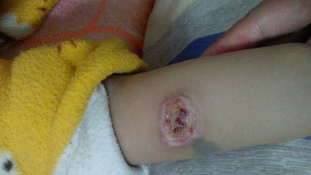 女儿手臂烫伤摸了烧伤膏结痂昨天被衣服曾掉了,还需要摸烧伤膏吗?