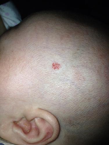 首页  为您推荐: 其他回答 病情分析: 你好,看图片属于一个毛细血管瘤