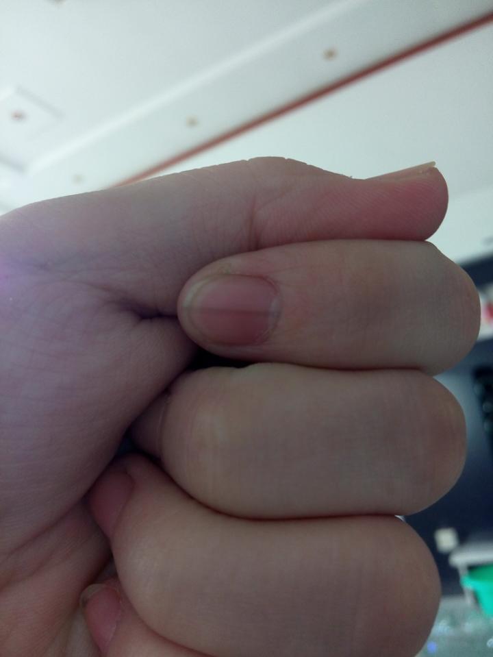 我的左手指甲盖上总是有条黑线是怎么回事