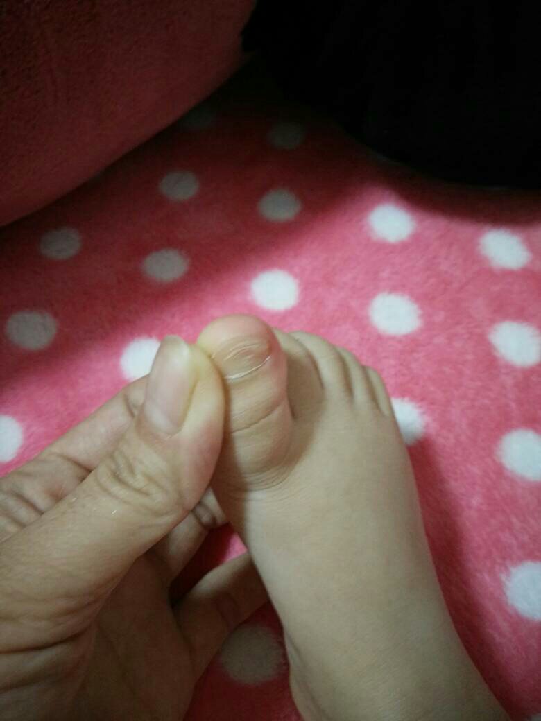18个月宝宝,脚趾甲里面发白,脚指甲起皮,怎么事,急急急
