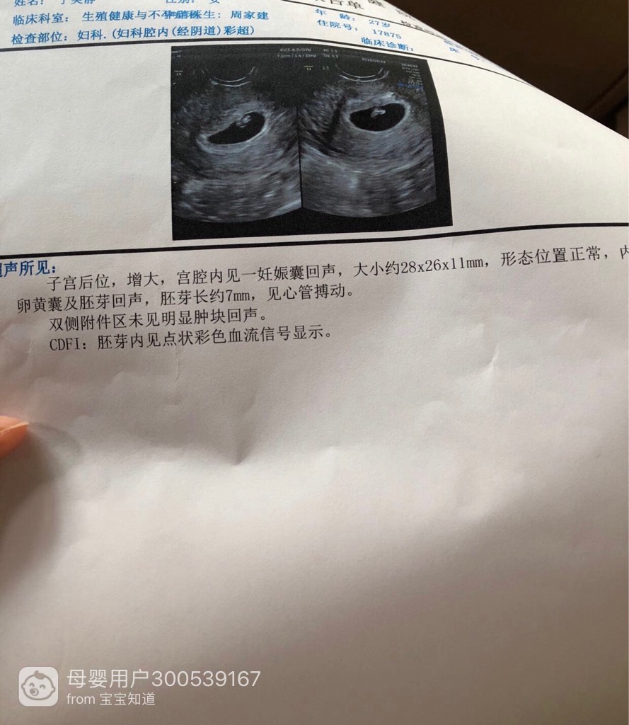 怀孕42天胎儿图片图片