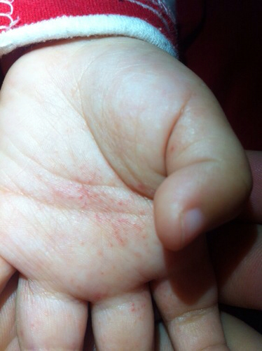 宝宝手掌有红斑点图片图片