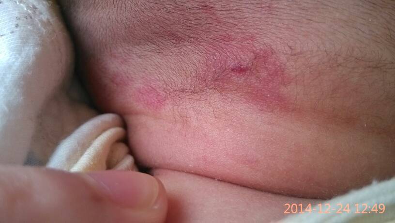 宝宝后头长的这个是胎记吗?