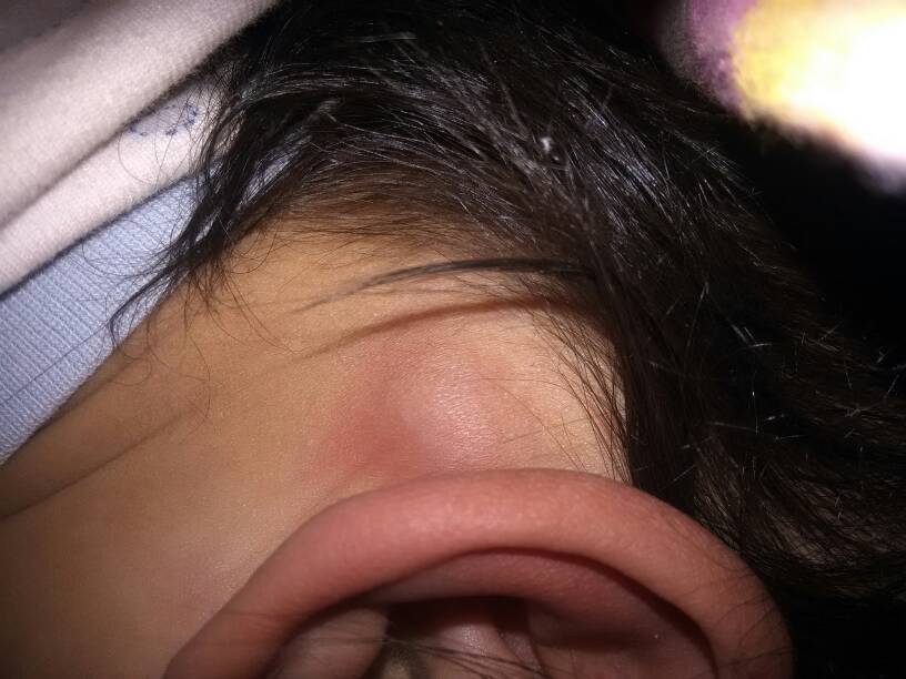 宝宝耳朵后筋疙瘩图片图片